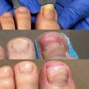 문제성발톱을 관리해주는 디에고푸스 녹번점 마이네일 후기 +원장님의 꼼꼼한터치