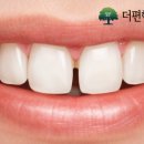 당진치과의원 | 당진치과, 앞니 레진 금방 떨어지거나 변색되지 않을까요?