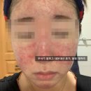 크림 | 수란트라크림 부작용 후기 (피부과X)