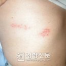 50대 여성 환자의 대상포진 예방 운동법 - 2013.4.22.일스外 이미지