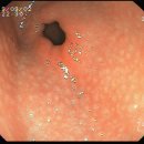 [위내시경] lymphofollicular gastritis(림프여포성 위염) 이미지