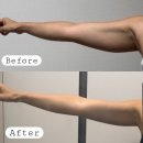 송도하나요양병원 | 팔뚝지흡 가격 후기 송도다이어트병원 3개월차 리얼 변화