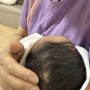 지니성형외과의원 | 13개월 아기 선천성 피지선 모반 제거 - ① (병원 선택)