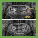 옥산치과의원 | 매복사랑니 발치 잘하는 곳 ‘섬세한사랑니치과’