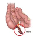 급성 충수염(Acute appendicitis) 이미지