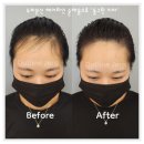 분당-318 | 분당두피문신 잘하는곳 여자 정수리 이마 헤어라인 m자탈모 후기