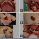 힐치과의원 | [힐치과] 치아재식술 성공 후기_송파구 치아재식술