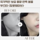 강남피부과 힐로웨이브 후기 앞광대 꺼짐 자연스럽게 채운 콜라겐 부스터