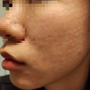 리쥬란 힐러 솔직 후기(추천 100%) 결제내역 첨부