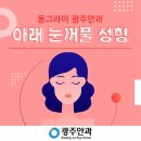 [광주눈매교정] 광주안과 아래 눈꺼풀 성형은 어떻게 진행되나요? 이미지