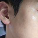 서울외과의원 | [충남 논산] 연무대 서울외과의원, 피부 레이저치료 후기! (Before &amp; After)