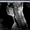 2009년 11월 14일 토요일 교통사고후 MRI 판독 사진 이미지