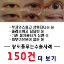 쌍꺼풀흉터 그냥 두고만 있을건가요? 이미지