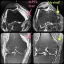 임일재정형외과의원 | 급성 무릎 슬개골 탈구 및 대퇴슬개내측인대파열 (MPFL) 완전파열 후기