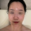 마인 | [평택/고덕] 피코토닝 물방울 리프팅 후기 - 더마인 에스테틱