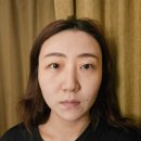 서초다이어트한의원 1회차 지방분해 라인약침 후기