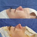 아우라성형외과의원 | 강남 성형외과 발품 후기/ 아우라 성형외과 남자 코 수술 후기