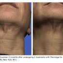 자모스프링여성의원 | 광주 상무지구피부과 논문으로 살펴본 써마지 후기 효과 (진료과목:피부과)