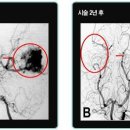 뇌동정맥 기형 이미지