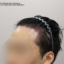 2988 | 30대모발이식 후기｜비절개 라인컷 2988모 구렛나루 포함 헤어라인 디자인 변화