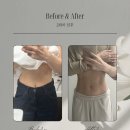 지나라인 | 신사비만클리닉의원 하프해진 러브핸들 옆구리라인 변화 후기 2주차