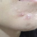 테라중기 | 속 여드름 염증주사 고인물의 가격, 패임, 효과, 주기, 후기 총정리
