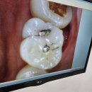 라이프치과의원 | 칠곡 라이프치과 내돈내산 후기