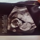 (주)동행플러스 | 유산 후 재임신 임신 12~20주 후기(니프티검사 결과)