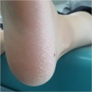 군자발각질제거 관리로 자신감 상승 욜로네일스튜디오 닥터아이티엔 광진점 내성.무좀.각질