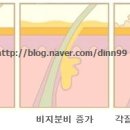 지루성피부염: 지루성피부염이란? 이미지