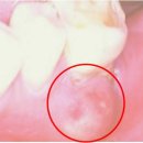 치주 농양[Periodontal abscess]치과질환 이미지