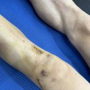 케이원메디(K1MEDI) | [K-MEDI] 전방십자인대(ACL) 재활 운동 후기 2편(3주차) / 지축재활 / 일산재활 / 서울 근교 재활...