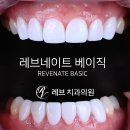 스타일치과기공소 | 베이직. 치아미백과 치아교정을 한번에! 치아삭제 사진 있음. 신사역 치과 앞니라미네이트 모델/비용/후기.
