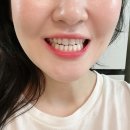 라미네이트 잘하는 곳, 서울강남치과 제로네이트 상담, 치아 본뜬 후기