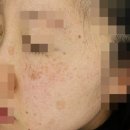 석피부과의원 | 장지동 피부과 피코토닝만으로 기미가 제거될까?
