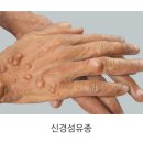 신경섬유종증[neurofibromatosis] 이미지