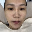 웰코멧 | 광주 피부관리 연예인 물톡스필링 체험기 뷰티스맑은피부과 에스테틱