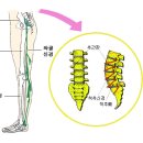 좌골 신경통 및 엉덩이 허벅지 무릎아래 정강이통증 이미지
