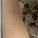 오체안피부과의원 | 오체안피부과양주점 두드러기검사 MAST검사 피검사후기 내돈내산