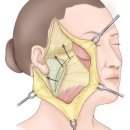 얼굴 주름 제거 성형술[face lift] 이미지