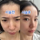 티엠바이오 | [대구피부과]에서 내성적은 티엠버스 보톡스. 이마,미간에 시술받은후기-!