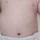 시원약국 | 부천 백피부과 후기 ㅡ습진,신생아피부거침