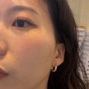 동호의원 | 압구정역피부과 쿨소닉 잘하는곳 후기 전후비교 통증(아르나의원)