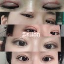 내돈내산 쌍커플 수술 후기(부분절개,부분마취,노원연세성형외과)