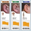 독일 베스트 보청기 이미지