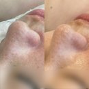 내포 피부관리 라비유에스테틱 모공디톡스+해열관리 후기