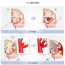 뇌졸중 이미지