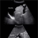 간경변 Liver Cirrhosis 이미지