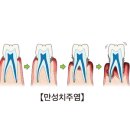 만성 치주염 (Chronic periodontitis) 이미지