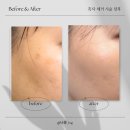 대구대명초등학교 | [피부/미용] 대구 흑자 제거, 기미 제거 후기 ‘끌레어뷰티’